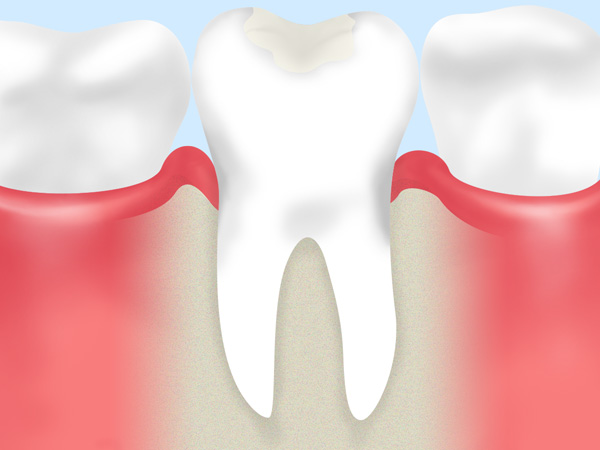 乳歯の虫歯は「白い」